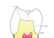 7 mm 0.2 0.3 mm Veneer Labial: Incisal third: Central third: Cervical third: on average at least 0.5 mm 0.5-0.7 mm 0.5 mm 0.2-0.3 mm Premolar crown 1.5 mm 1.