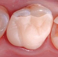 CLINICAL CASE First upper molar