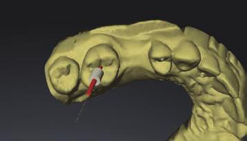 SICAT Endo and ACCESSGUIDE 22/23 More than 3D - the first dedicated guided endo solution.