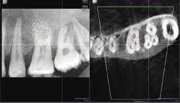 which can also support you in the realiziation of guided root canal treatment.