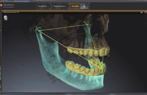 The CEREC optical scan provides the occlusal surface data necessary to produce a precise-fitting, optimally functional OPTISLEEP appliance.