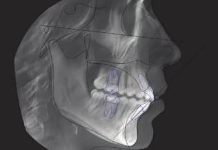And now, with Sidexis 4, FaceScan is integrated into one diagnostic software. Integrated implantology Implants with a final prosthesis in fewer visits.