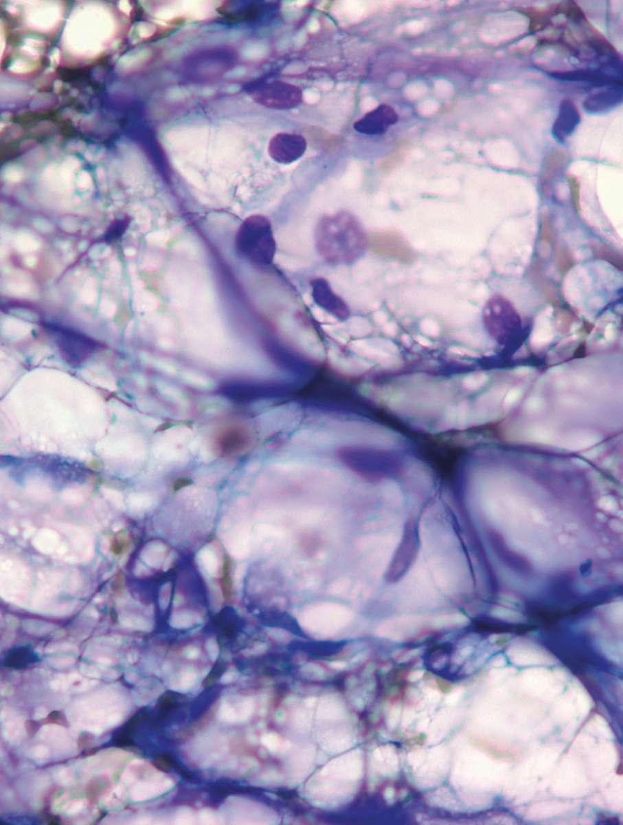 A Peer-Reviewed Journal Cytology of Neoplasia An Essential