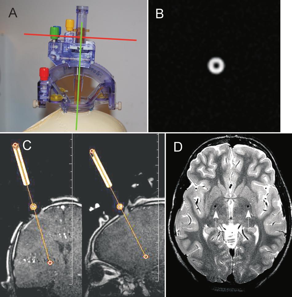 ClearPoint system for DBS in pediatric dystonia Fig. 3. SmartFrame alignment and confirmation of stylet placement.