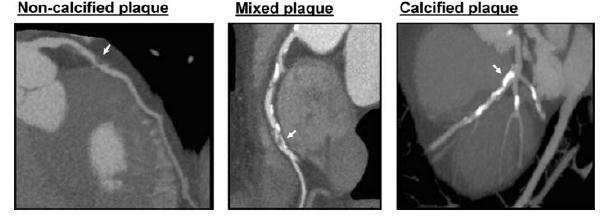 CTA and prognosis (2) CCTA plaque characteristics with potential prognostic value Stenosis