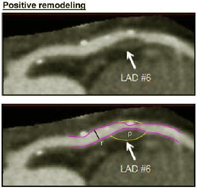 intraluminal stenosis Left main, LAD Mixed composition; low attenuation density (<30 Hounsfield