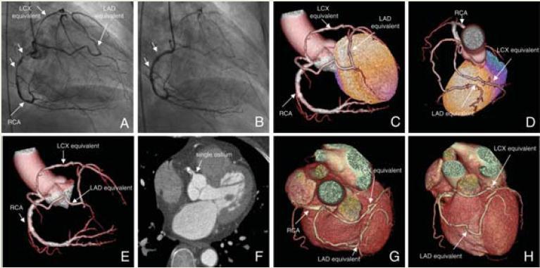 Cardiac hybrid imaging in a patient with a single coronary artery originating