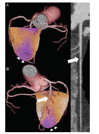 Impact of cardiac hybrid SPECT/CT imaging on choice of treatment strategy in