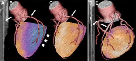 Prognostic value of cardiac hybrid imaging integrating SPECT with