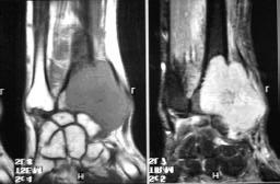 4 T1 and STIR coronal MR image of lower forearm and hand demonstrating invasion of joint in a