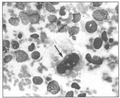 Smears from osteosarcoma showed high cellularity with dissociated single osteoblastic cells and occasional short rows or clusters of cells (Fig. 3).
