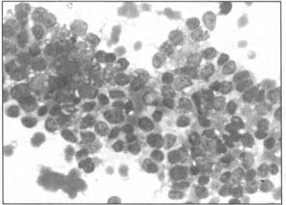 Cellularity was moderate in giant cell tumours and consisted of ovoid to plump stromal cells that were dissociated or clustered (Fig. 8).