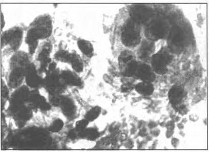 The tumour cells were large and physaliferous with abundant vacuolated to clear cytoplasm and vesicular nuclei with a few binucleated forms.