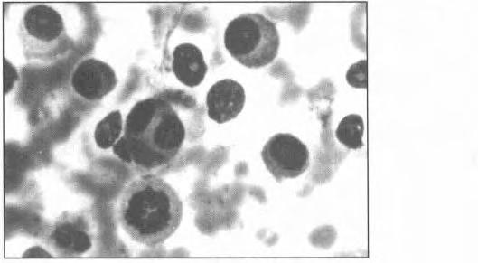 Three cases of poorly diferentiated sarcoma showed dissociated spindle cells, plump cells and tumour giant cells with prominent pleomorphism and mitotic activity.