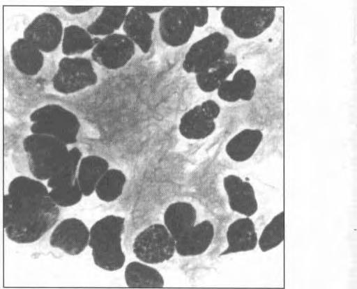 Malaysian J Path01 December 1994 FIG. 11: Cluster of clear cells in metastatic renal cell carcinoma.