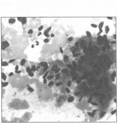 FNA OF BONE TUMOURS FIG. 13: Smear from metastatic fibrosarcoma showing dissociated and clustered spindle and ovoid cells. Cluster on the right is associated with stroma-like material.