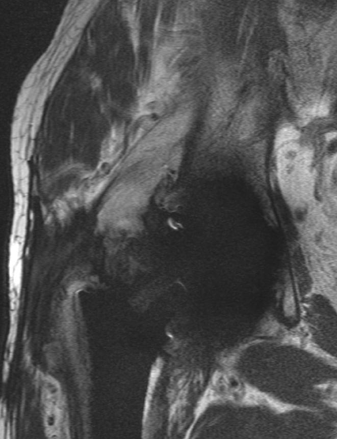 Posttreatment imaging: Optimal MRI e» s y r g u
