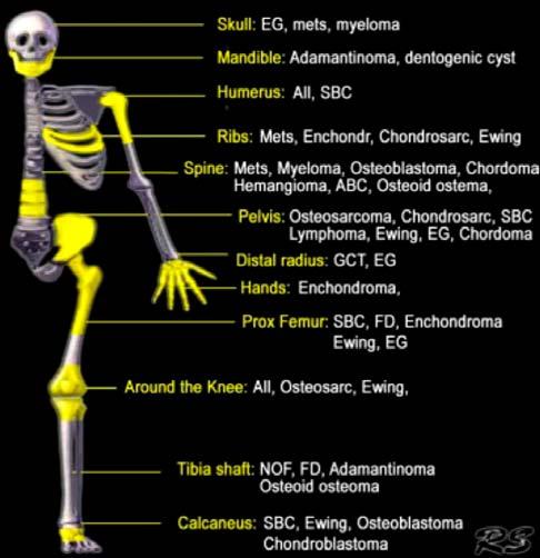 Tumor Localization Most bone tumors often occur in a characteristic location in the skeleton - axial versus appendicular skeleton - long versus flat bones - predilection for