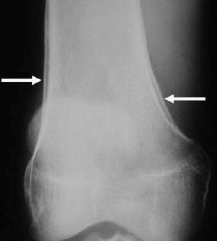 Periosteal reaction Hypertrophic osteoarthropathy in a