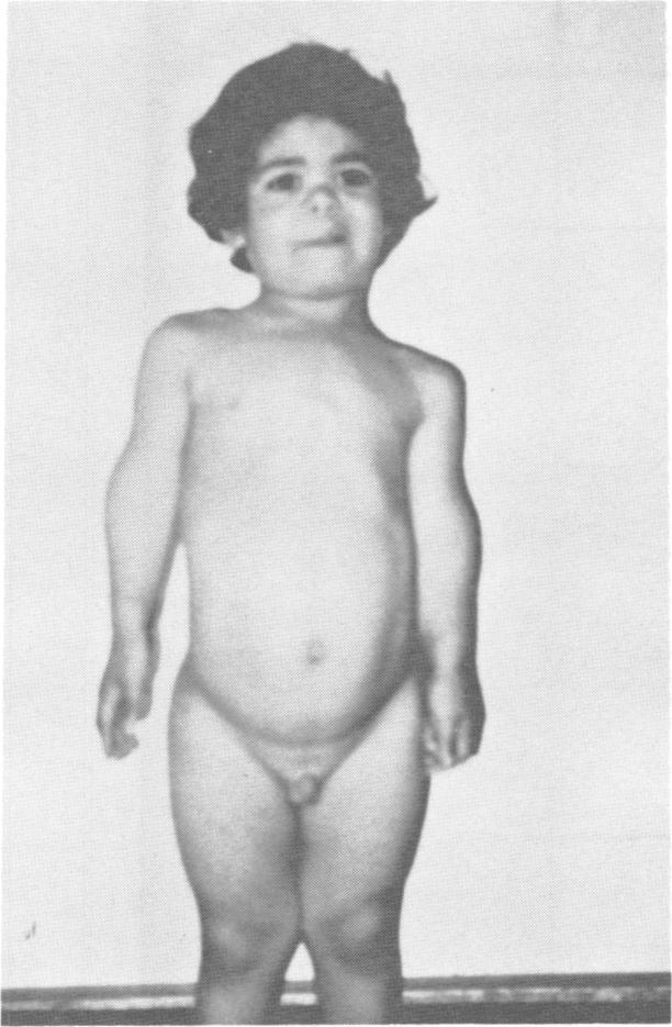 Journal of Medical Genetics 1987, 24, 597-601 A family with spondyloepimetaphyseal dwarfism: a 'new' dysplasia or Kniest disease with autosomal recessive inheritance?