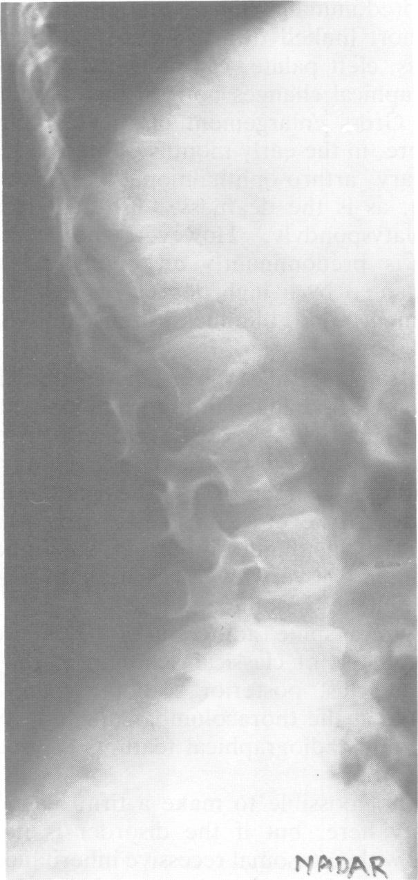 A family with spondyloepimetaphvseal dwarfism FIG 5 Platyspondyly is not marked in the lumbar region by the age ofsix years, but pedicles are short, with scalloping of the posterior border of the