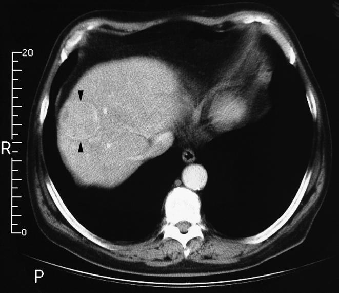 The initial investigation should be α-fetoprotein in a noncirrhotic patient where the first presentation is a liver mass.