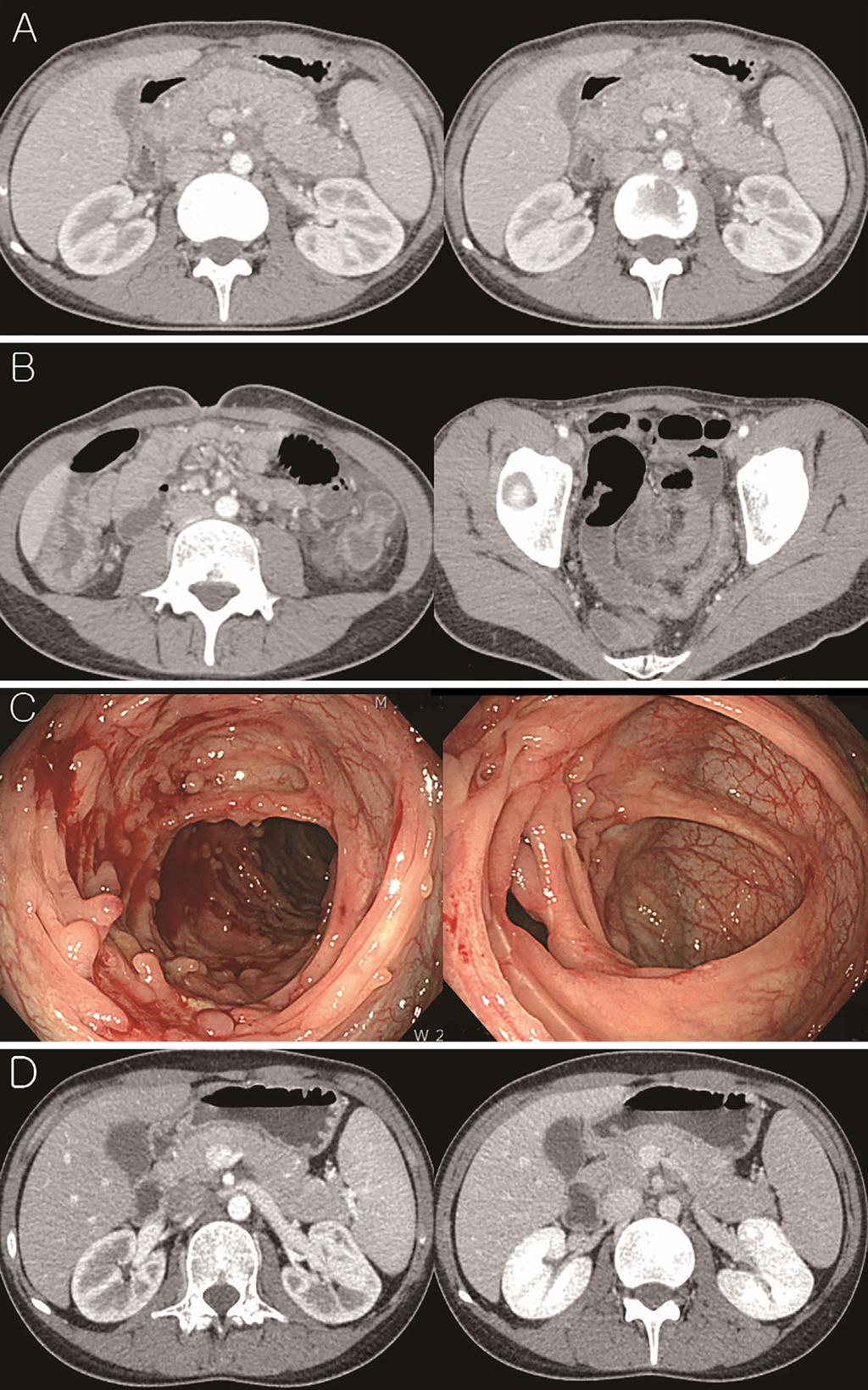 Figure 1. Axial abdominal computed tomography. A: Diffuse enlargement of the pancreas with a peripheral rim of low attenuation and minimal peripancreatic fluid collections.