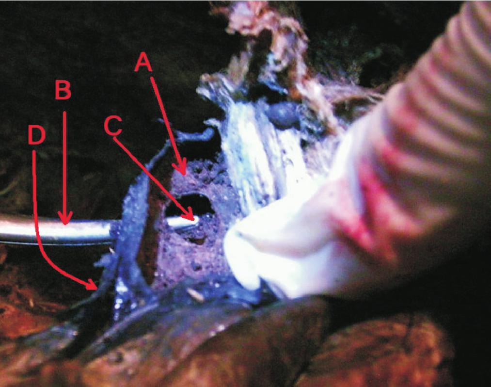 Fig-6: Showing formation of Musculocutaneous nerve on the left side by union of two branches arising