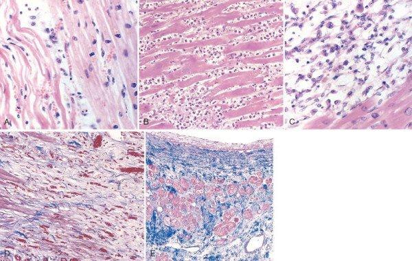 Pathology: Myocardium biopsies taken at different times after a myocardial infarction are shown below: A: 1 day post infarct. B: 2-3 days. c: 7 days. D: 10 days. E: 2-3 weeks.