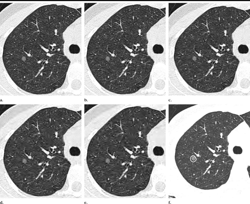 Transverse CT images at the same anatomic level show a nodule with ground-glass attenuation at image compression levels of (a) 1:1 (no compression), (b) 10:1, (c) 20:1, (d) 30:1, and (e) 40:1.