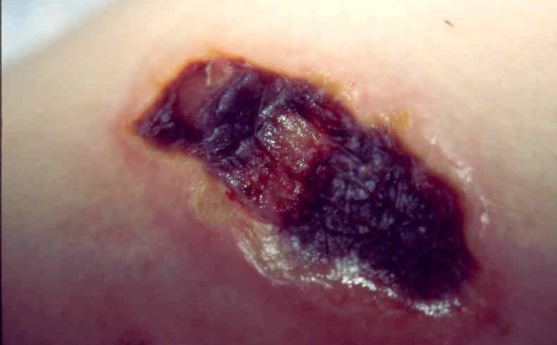 Hydrogel Dressings (cont d) Types of wounds appropriate for use of a Hydrogel