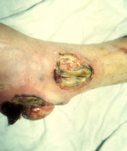 debridement and help decrease the amount of necrotic tissue Exposed tendons