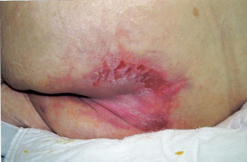 Hydrocolloid Dressings Types of wounds appropriate for use of a Hydrocolloid Dressing