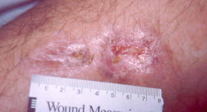 Transparent Film Dressings (cont d) Types of wounds appropriate