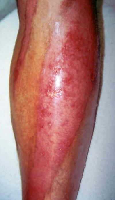 healing lower leg wound with minimal exudate Full thickness