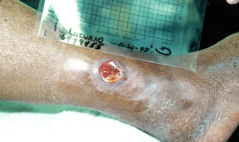 Composite Dressings (cont d) Types of wounds appropriate for use