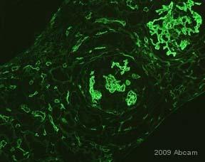 Antibody mediated kidney rejection Rise in creatinine 14 days post
