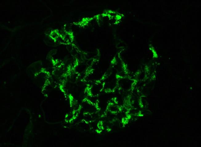 Direct Immunofluorescence: Kidney Diagnosis HPI Findings Picture IgA nephropathy Synpharangitic nephritic syndrome Rapidly declining renal