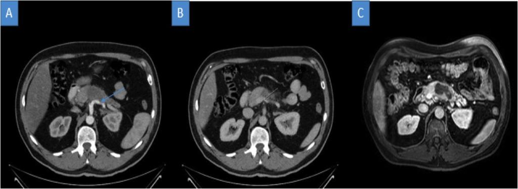 Fig. 2: Adenocarcinoma. (A) Postcontrast arterial phase CT shows a homogeneous hypovascular mass of 2.5 cm in uncinate process. Vesicular distension.