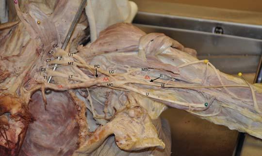 Brachial Plexus Brachial Plexus Consists of ventral rami of the C5-T1 nerve roots.