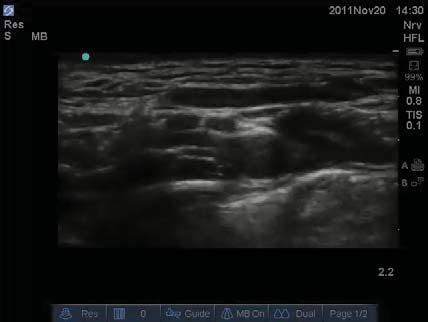 hypoechoic circles lateral to subclavian artery,
