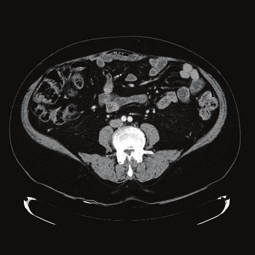 Patient completed six cycles of rituximab, cyclophosphamide, doxorubicin, vincristine, and prednisone (R-CHOP) with complete response demonstrated by CT, that is, total resolution of the abdominal
