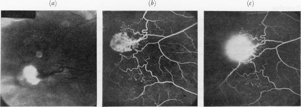 3 646 Patrick L Condon, Robert Gray and Graham R. Serjeant looping of peripheral venules, were present in 28 eyes (I4 patients).