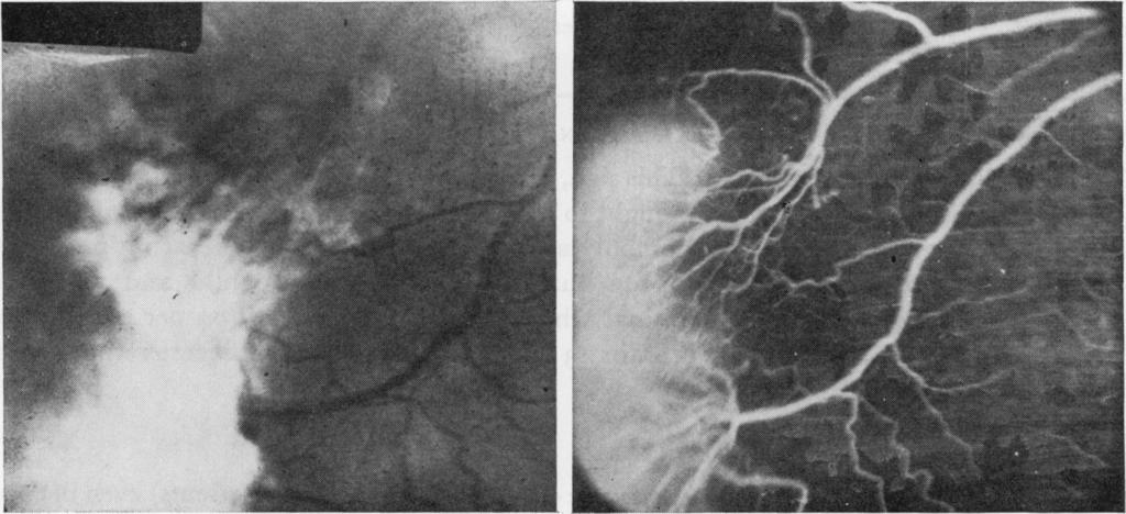 Severe changes with arteriolar occlusions were noted in 25 eyes (I 7 patients) and occurred as early as 6 years of age.