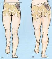 differences Hip stabilisation exercises Prone glutes Glute bridges Clams Side lying leg raises 4 point hip extension Ball hip extension Physio lunges * Step down * VMO