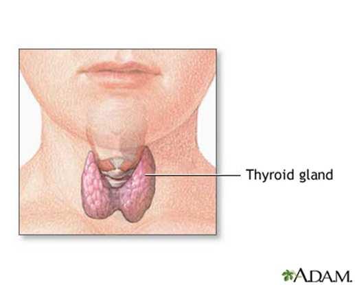 ASSOCIATED AUTOIMMUNE DISORDERS: o Autoimmune thyroid dysfunction
