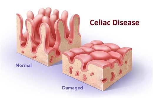 screening at any time if clinical suspicion o Celiac disease (4.
