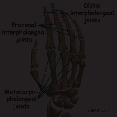 One such injury is an injury to the distal interphalangeal, or DIP, joint of the finger. This joint is commonly injured during sporting activities such as baseball.