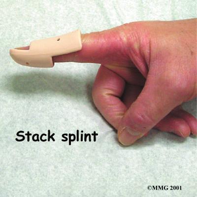 If there is no fracture, then the assumption is that the end of the tendon has been ruptured, allowing the end of the finger to droop.