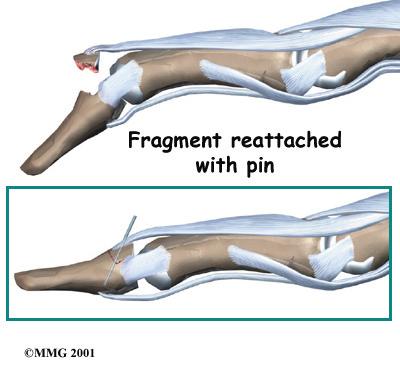 allow the patient to continue to use the hand. The pin is removed at six weeks. Splinting may even work when the injury is quite old.